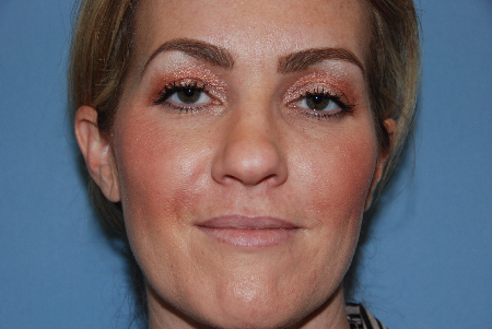 Before Image: Patient # 64249 - front