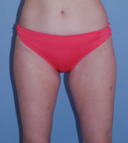 Before Image: Patient # 77218 - front
