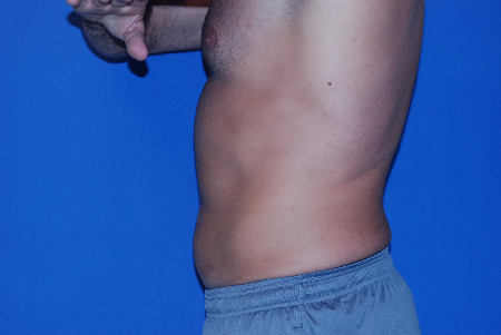 After Image: Patient # 76951 - front