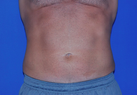 After Image: Patient # 76951 - front