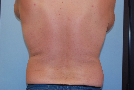 Before Image: Patient # 76951 - front