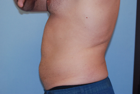 Before Image: Patient # 76951 - front