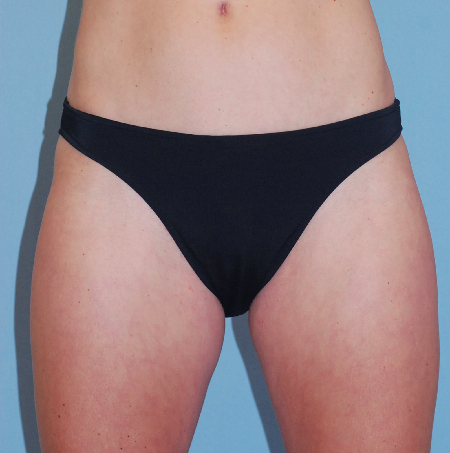 Before Image: Patient # 63663 - front