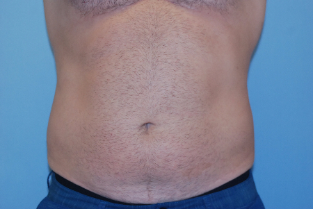 Before Image: Patient # 76951 - front