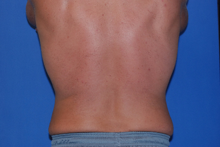 After Image: Patient # 76951 - front