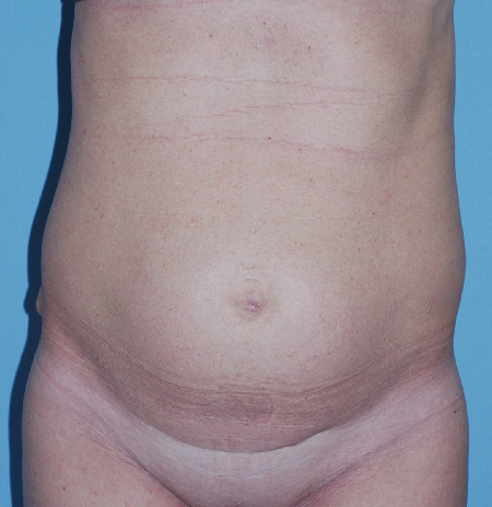 Before Image: Patient # 76758 - front
