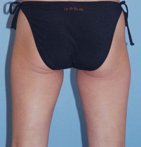 Before Image: Patient # 75680 - front