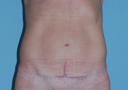 After Image: Patient # 76758 - front