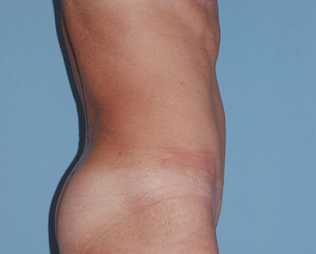 After Image: Patient # 76758 - front