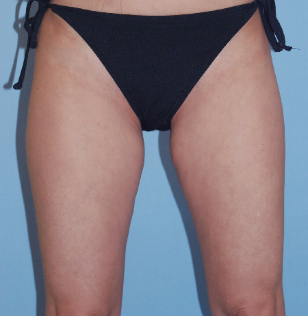Before Image: Patient # 75680 - front