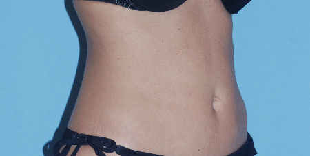 After Image: Patient # 10047 - front