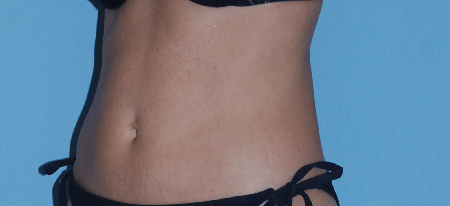After Image: Patient # 10047 - front