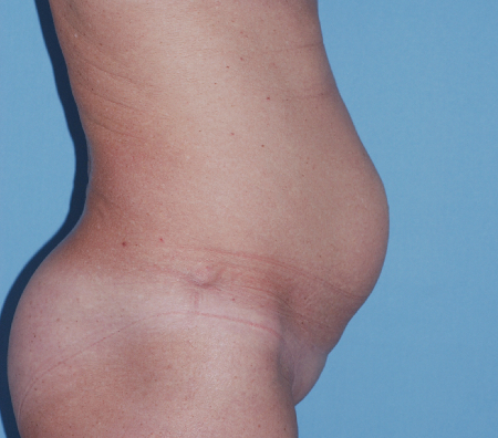 Before Image: Patient # 76758 - front