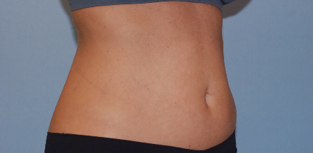 Before Image: Patient # 10047 - front