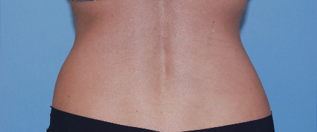 Before Image: Patient # 10047 - front