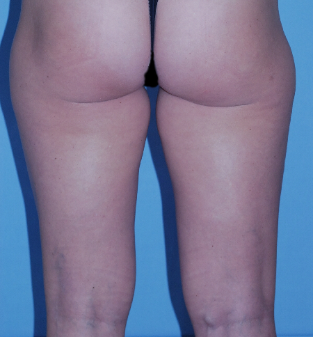 Before Image: Patient # 76945 - front