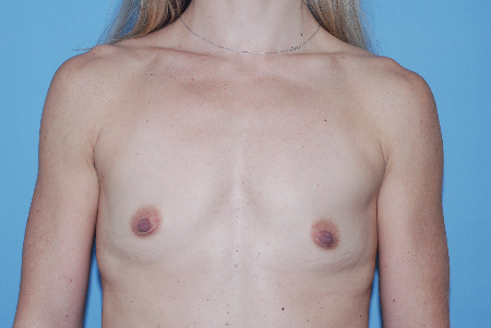 Before Image: Patient # 34058 - front