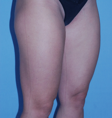 Before Image: Patient # 76945 - front