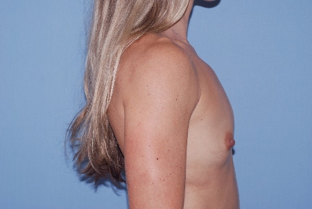Before Image: Patient # 34058 - front