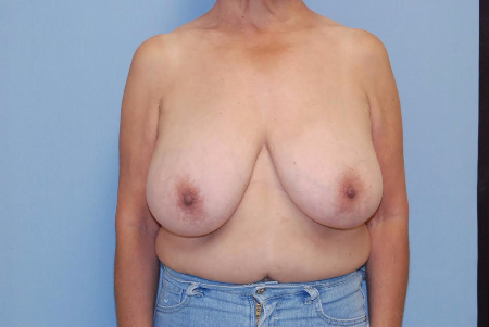 Before Image: Patient # 78654 - front