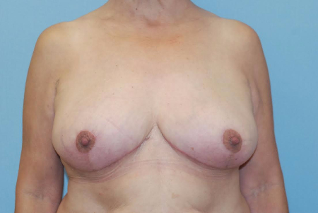 After Image: Patient # 78654 - front