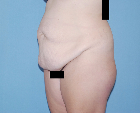 Before Image: Patient # 19402 - front