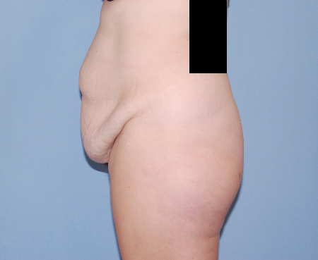 Before Image: Patient # 19402 - front