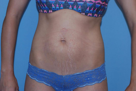 Before Image: Patient # 31477 - front