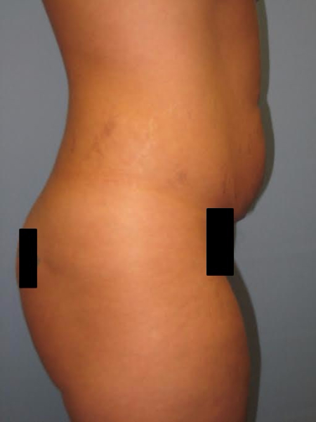Before Image: Patient # 35643 - front