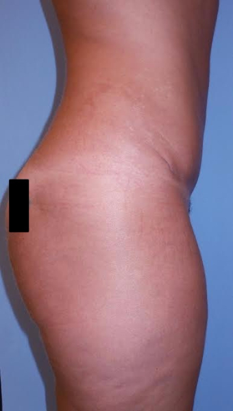After Image: Patient # 35643 - front