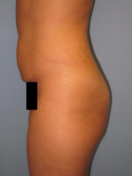 Before Image: Patient # 35643 - front
