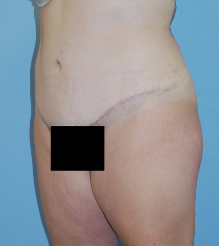 After Image: Patient # 19402 - front