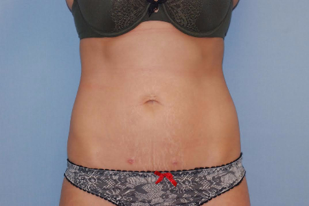 After Image: Patient # 31477 - front