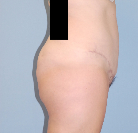 After Image: Patient # 19402 - front