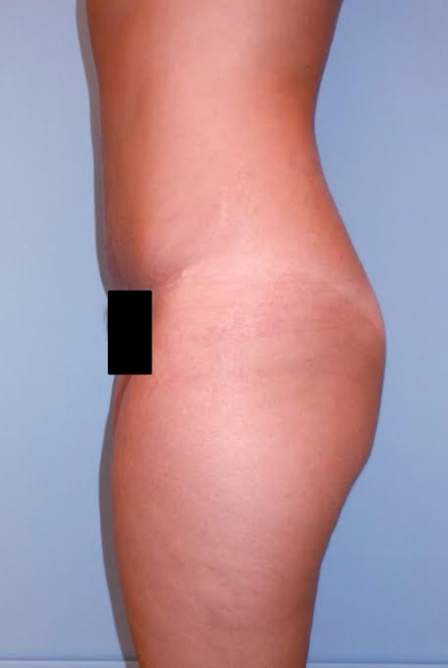 After Image: Patient # 35643 - front