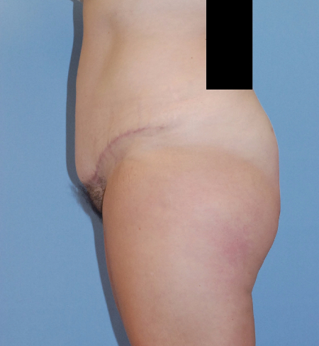 After Image: Patient # 19402 - front