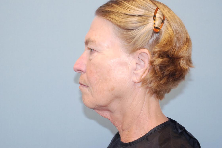 Before Image: Patient # 59479 - front