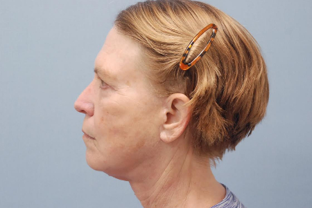 After Image: Patient # 59479 - front