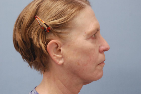 After Image: Patient # 59479 - front