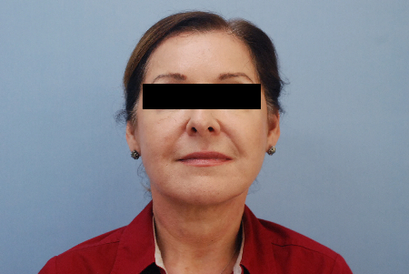After Image: Patient # 42181 - front