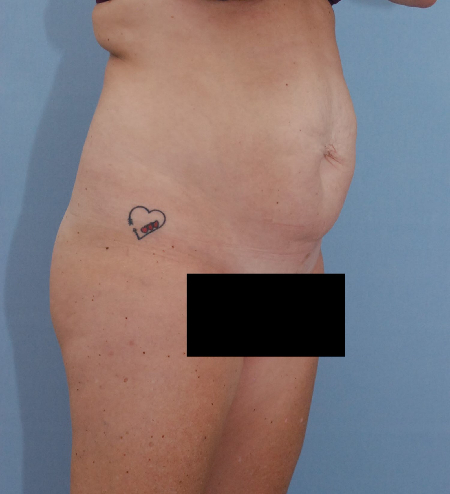 Before Image: Patient # 57469 - front