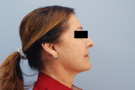 After Image: Patient # 42181 - front