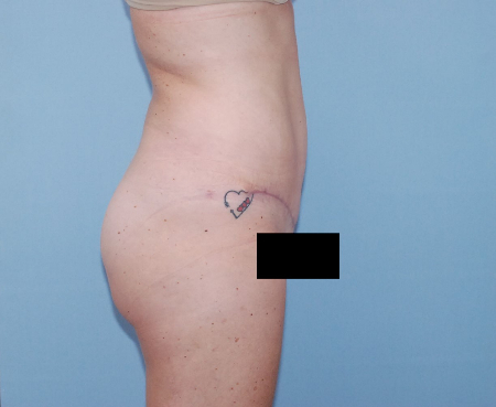 After Image: Patient # 57469 - front