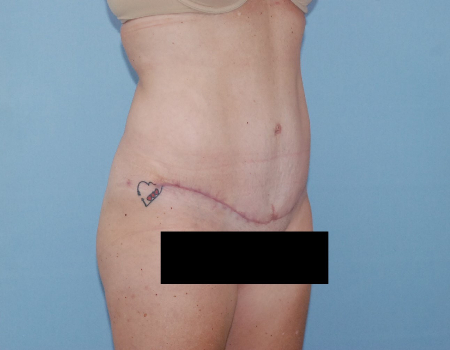 After Image: Patient # 57469 - front