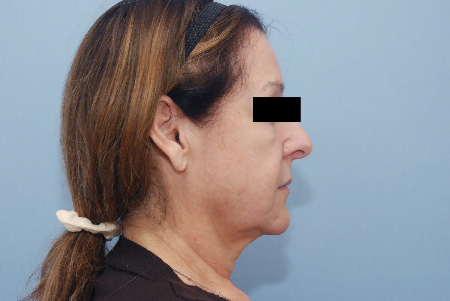 Before Image: Patient # 42181 - front