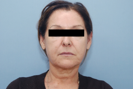 Before Image: Patient # 42181 - front