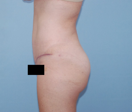 After Image: Patient # 57469 - front