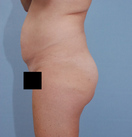 Before Image: Patient # 57469 - front