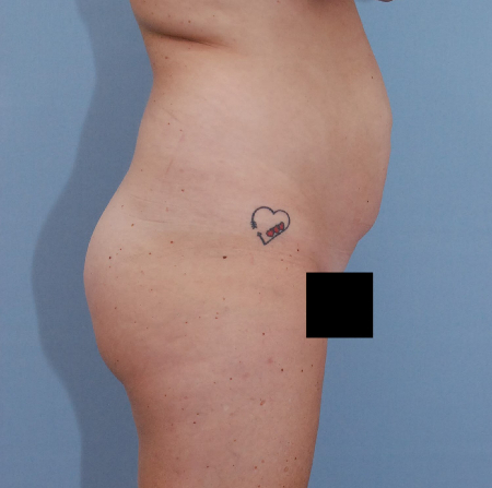 Before Image: Patient # 57469 - front