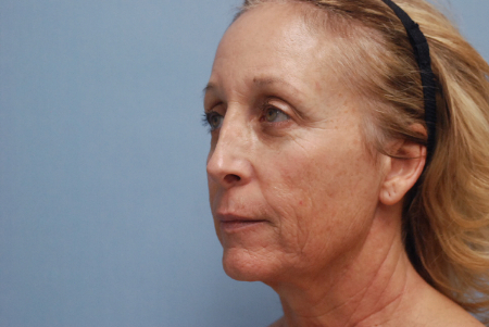 Before Image: Patient # 75149 - front